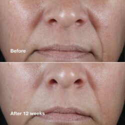 IMG_2669 سرم جوانساز هیالورونیک اسید و رتینوئید ۱ درصد اسمارت کلینیک