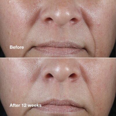 IMG_2669 سرم جوانساز هیالورونیک اسید و رتینوئید ۱ درصد اسمارت کلینیک