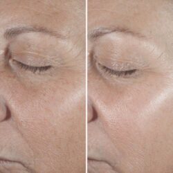IMG_2671 سرم جوانساز هیالورونیک اسید و رتینوئید ۱ درصد اسمارت کلینیک