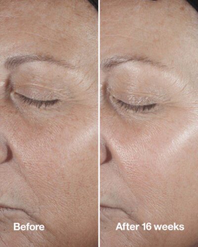 IMG_2671 سرم جوانساز هیالورونیک اسید و رتینوئید ۱ درصد اسمارت کلینیک