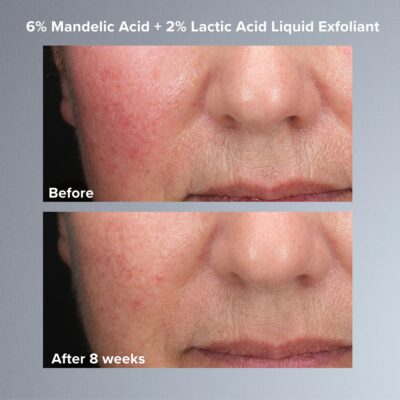 اسید مندلیک 6% و اسید لاکتیک2% پائولاز چویس Paula's Choice Skin Perfecting 6% Mandelic Acid + 2% Lactic Acid Liquid Exfoliant