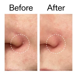 IMG_5192 پچ ضد جوش هیدروکلوئید نامرئی حاوی سالیسیلیک اسید | The INKEY List Hydrocolloid Invisible Pimple Patches